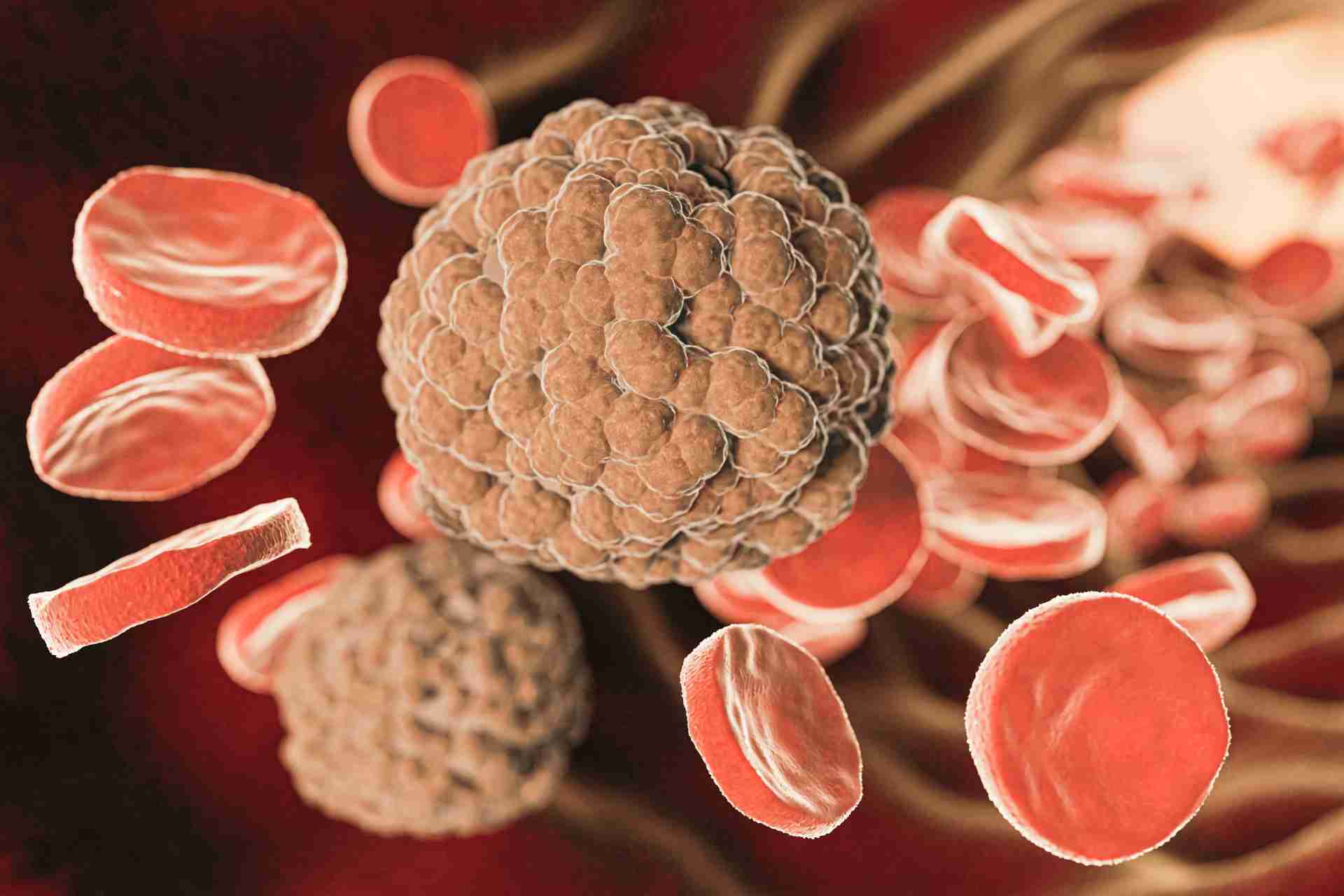 ساركوما إيوينغ (Ewing Sarcoma): الأعراض المبكرة وتأثيرها على الأداء الرياضي و الصحة
